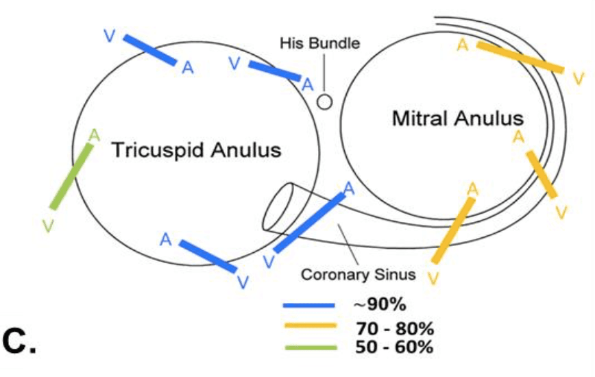 Schéma du trajet oblique des voies accessoires autour des anneaux mitral et tricuspide et de l’effet d’une stimulation différentielle