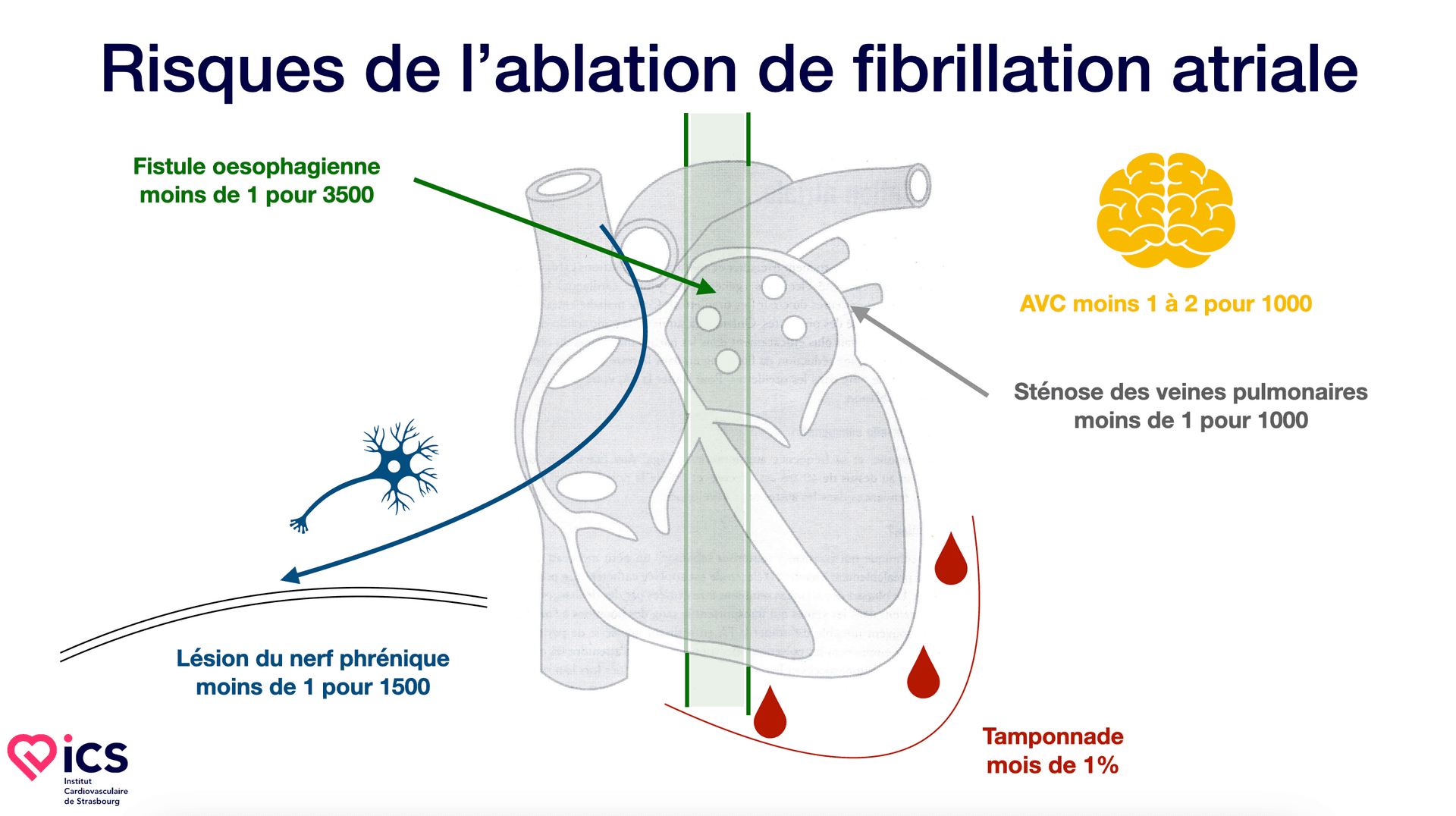 Quelles sont les complications possibles de l’ablation de la fibrillation atriale ?