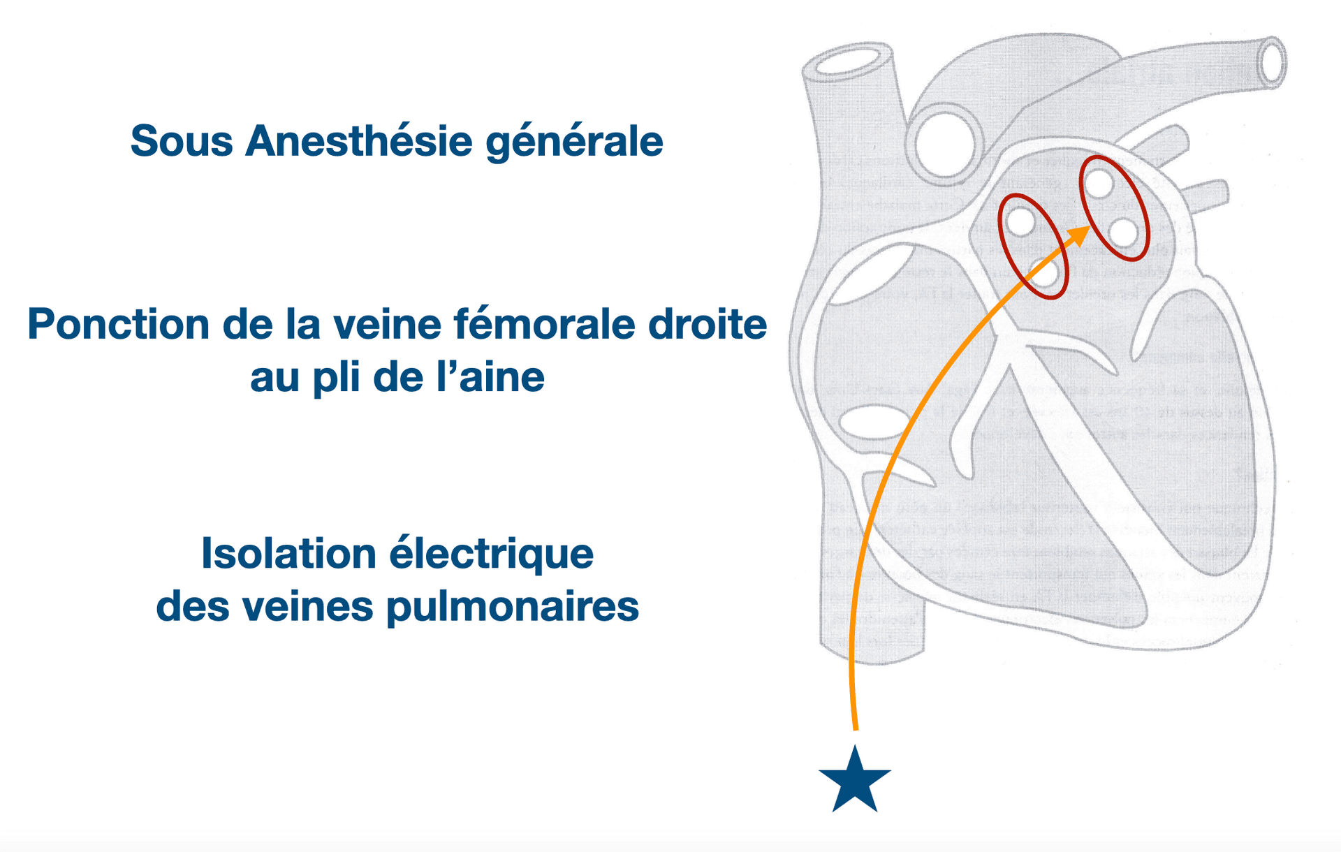 Comment se déroule une ablation de fibrillation atriale ?