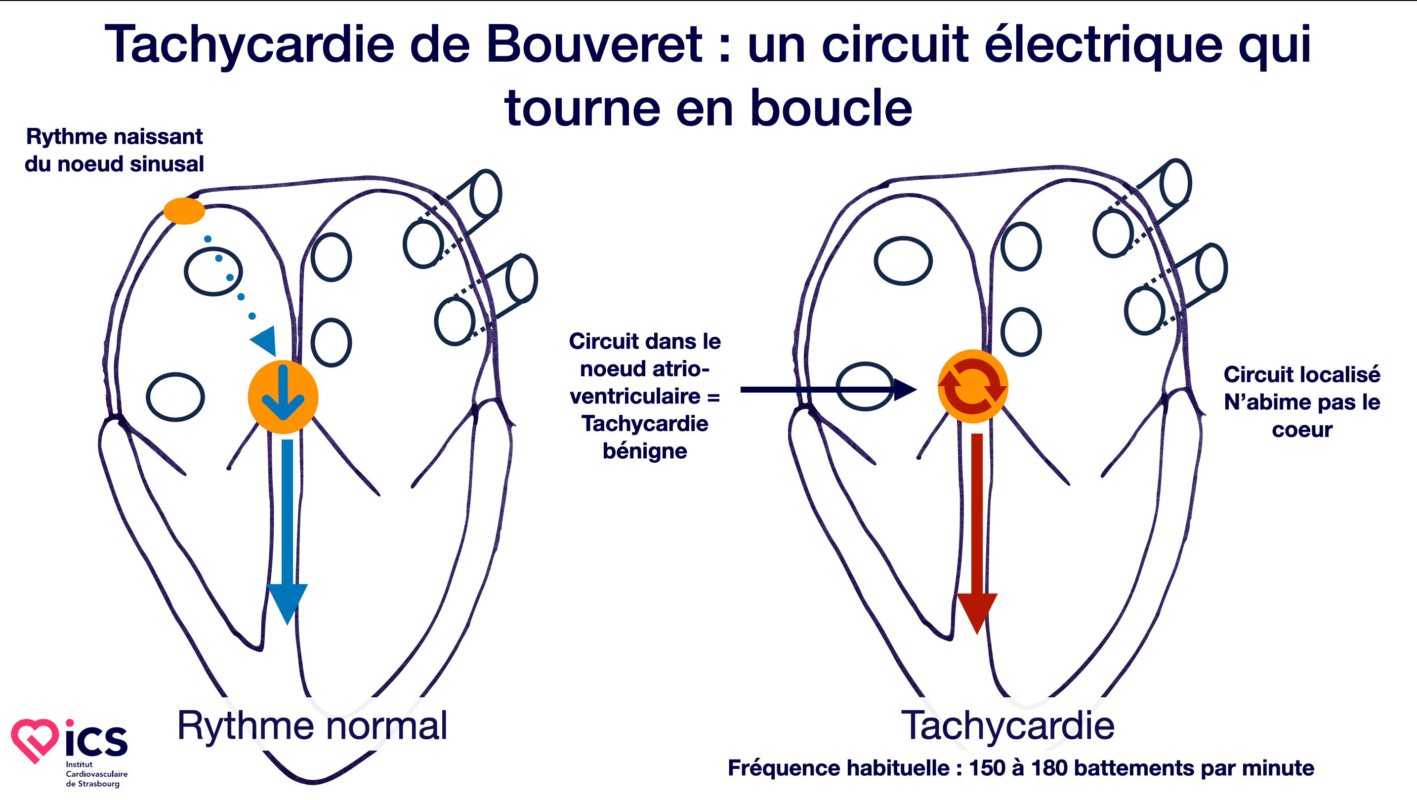 Tachycardie de Bouveret : symptômes, danger et traitement